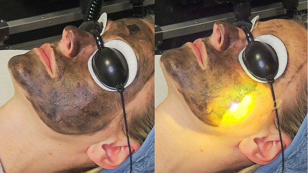 Uhlíková maska na tvári a laserový impulz pri ošetrení carbonpeel, oči chránené okuliarmi