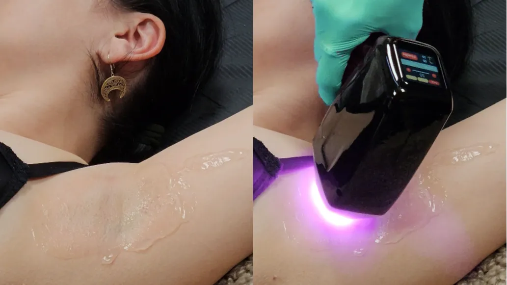 Laserová epilácia podpazušia diódovým laserom, na koži chladiaci gél